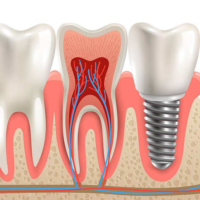 nevadent implant