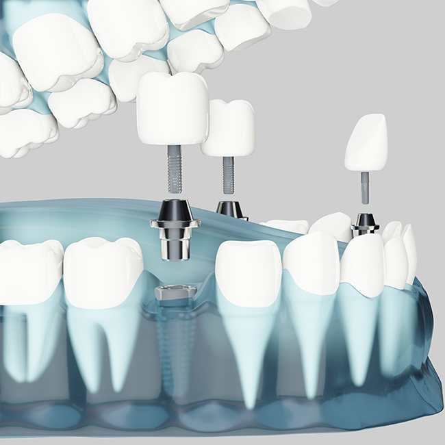nevadent implant